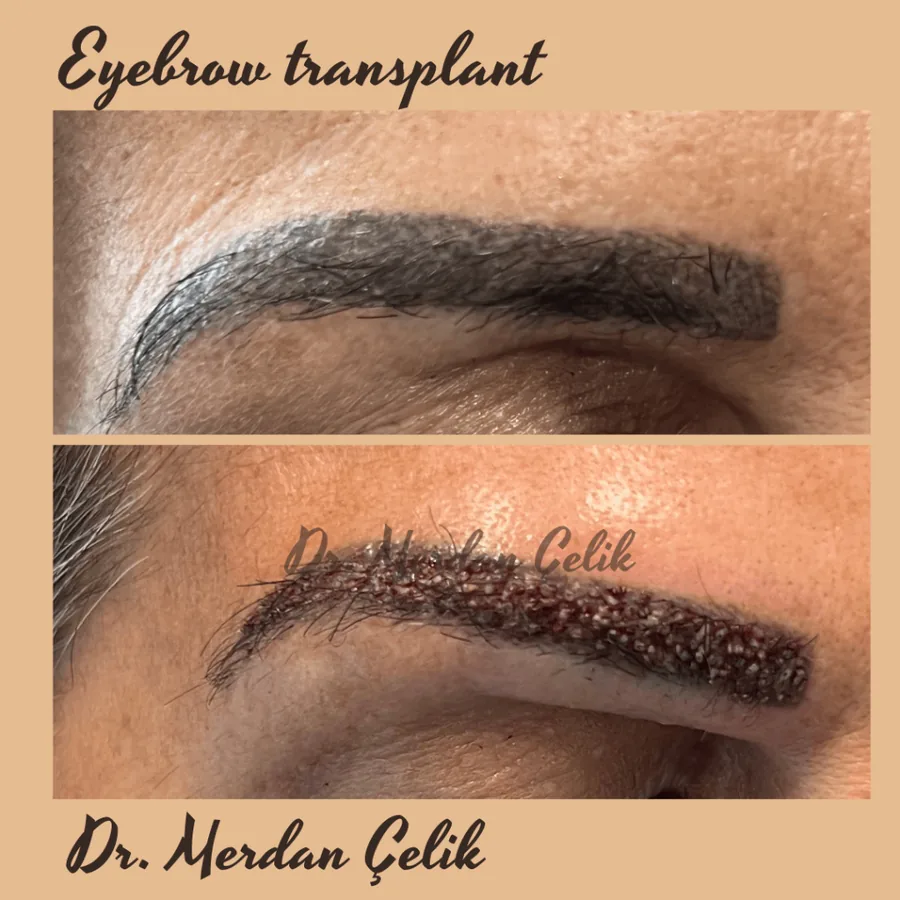 Primer plano de una ceja densa y de forma natural tras un trasplante de cejas